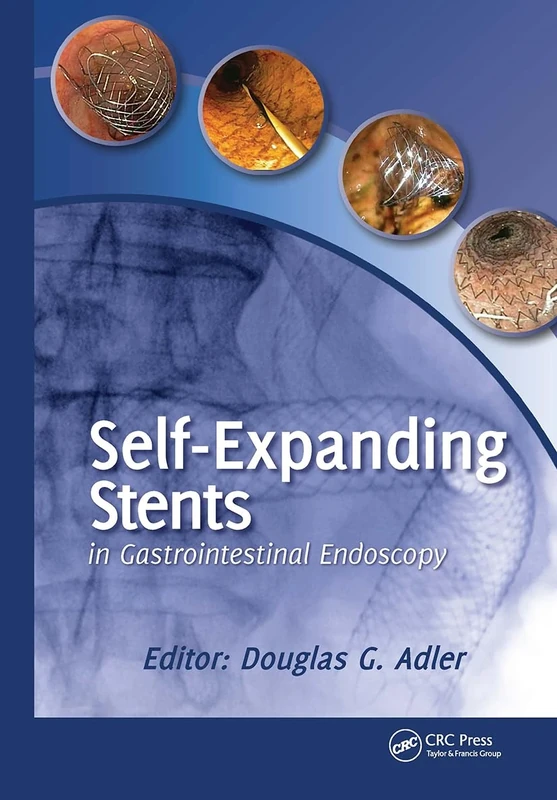 Self-Expanding Stents in Gastrointestinal Endoscopy