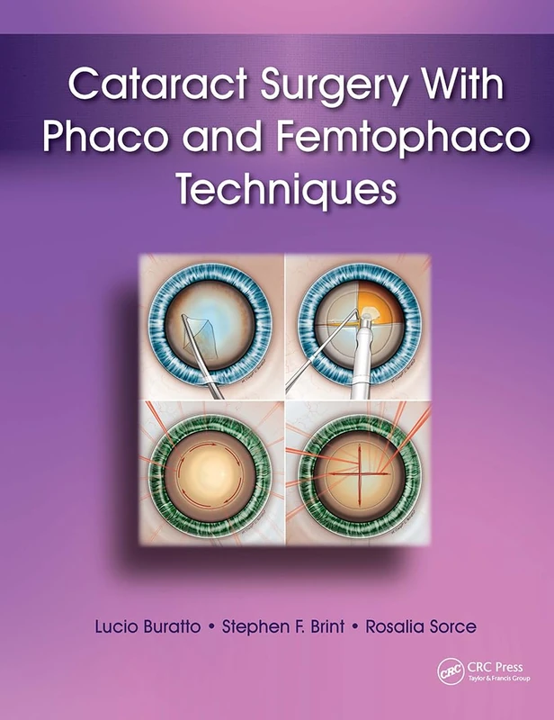Cataract Surgery With Phaco and Femtophaco Techniques