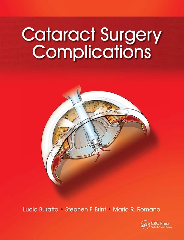 Slack Cataract Surgery Complications - Medical Reference Book