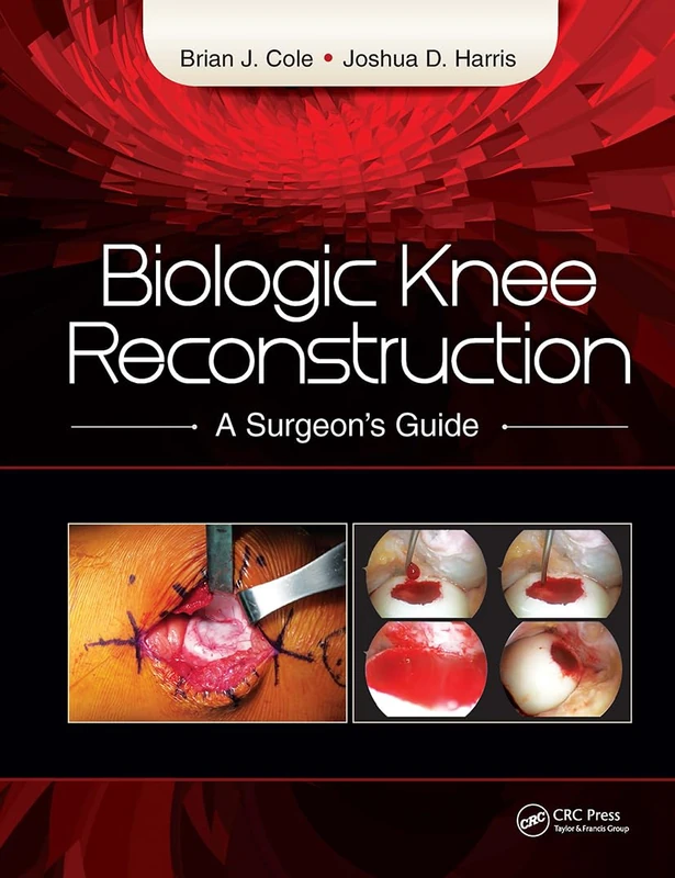 Biologic Knee Reconstruction: A Surgeon's Guide - Slack
