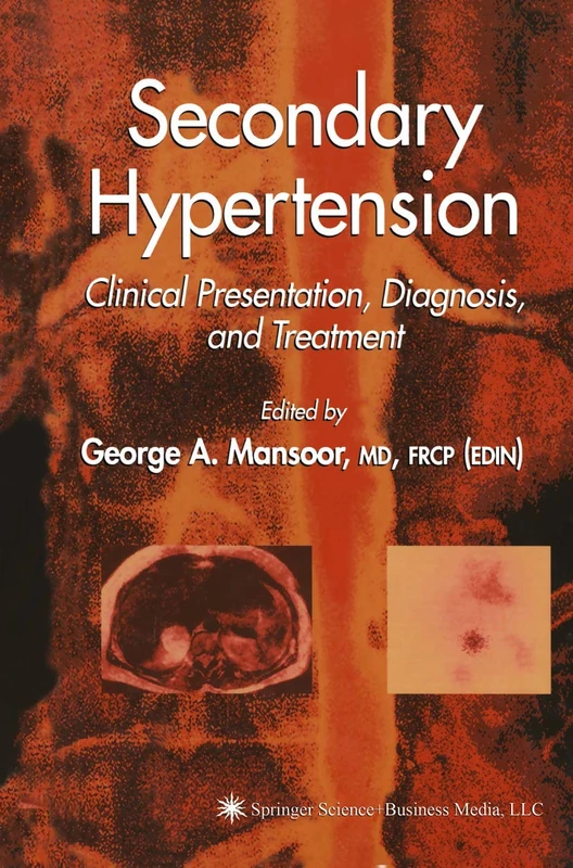 Secondary Hypertension: Clinical Presentation, Diagnosis, and Treatment (Clinical Hypertension and Vascular Diseases)