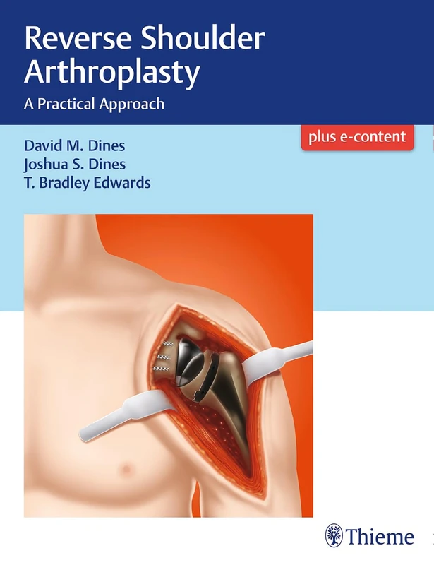 Thieme Reverse Shoulder Arthroplasty: A Practical Approach
