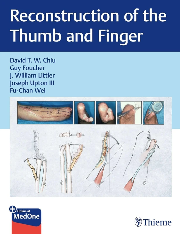Reconstruction of the Thumb and Finger - Image 1