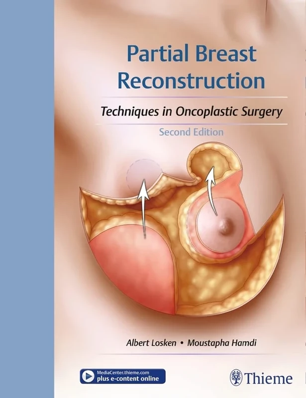 Partial Breast Reconstruction: Techniques in Oncoplastic Surgery - Image 1