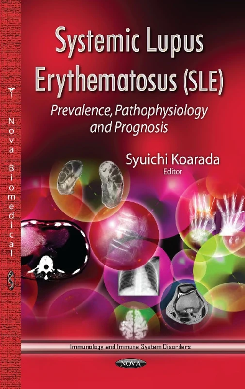 Systemic Lupus Erythematosus: Prevalence, Pathophysiology & Prognosis (Immunology and Immune System Disorders)
