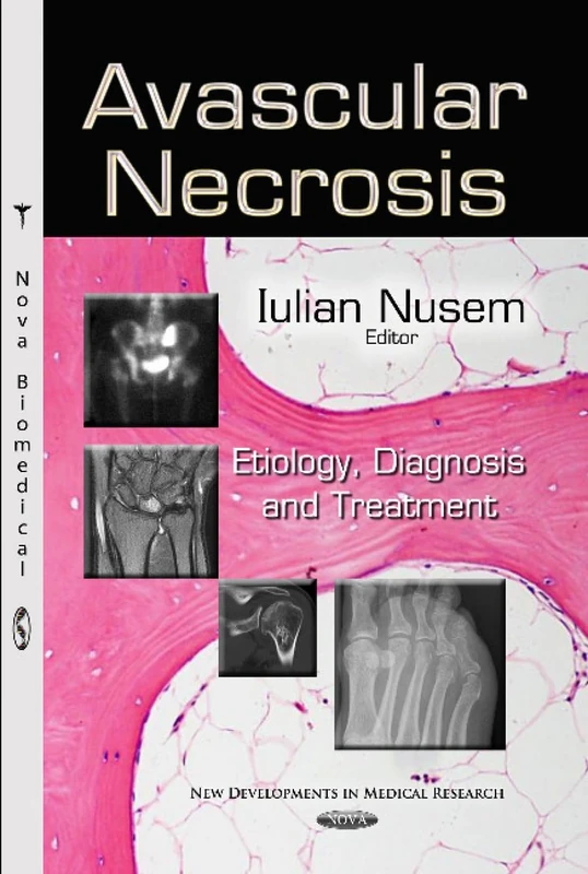 Avascular Necrosis: Etiology, Diagnosis & Treatment (New Developments in Medical Research) - Image 1