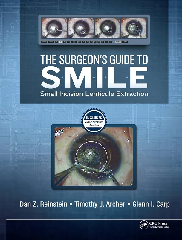 The Surgeon’s Guide to SMILE: Small Incision Lenticule Extraction - Image 1