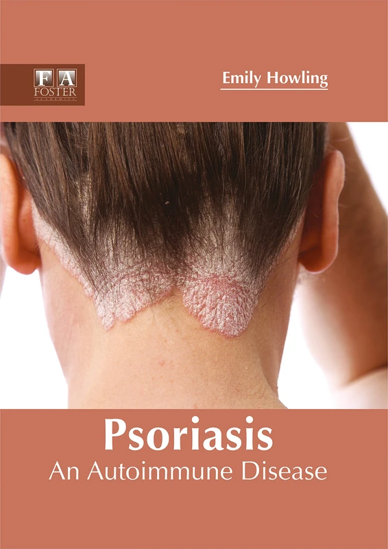 Psoriasis: An Autoimmune Disease