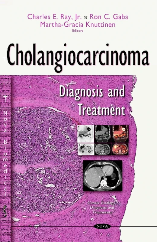 Cholangiocarcinoma: Diagnosis & Treatment (Cancer Etiology, Diagnosis and Treatments)