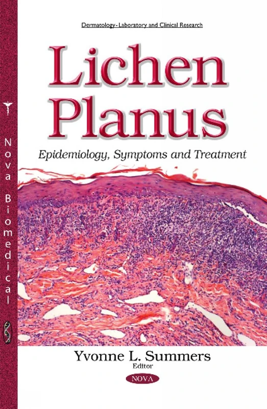 Lichen Planus: Epidemiology, Symptoms & Treatment