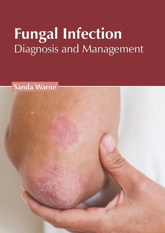 Fungal Infection: Diagnosis and Management - Medical Book