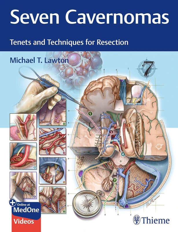 Seven Cavernomas: Tenets and Techniques for Resection