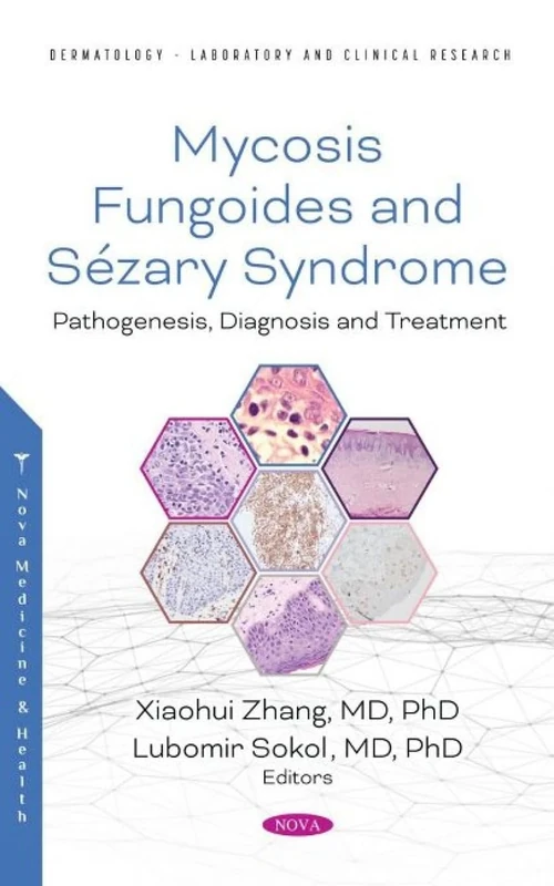 Mycosis Fungoides: Causes, Diagnosis and Treatment (Dermatology - Laboratory and Clinical Research): Pathogenesis, Diagnosis and Treatment