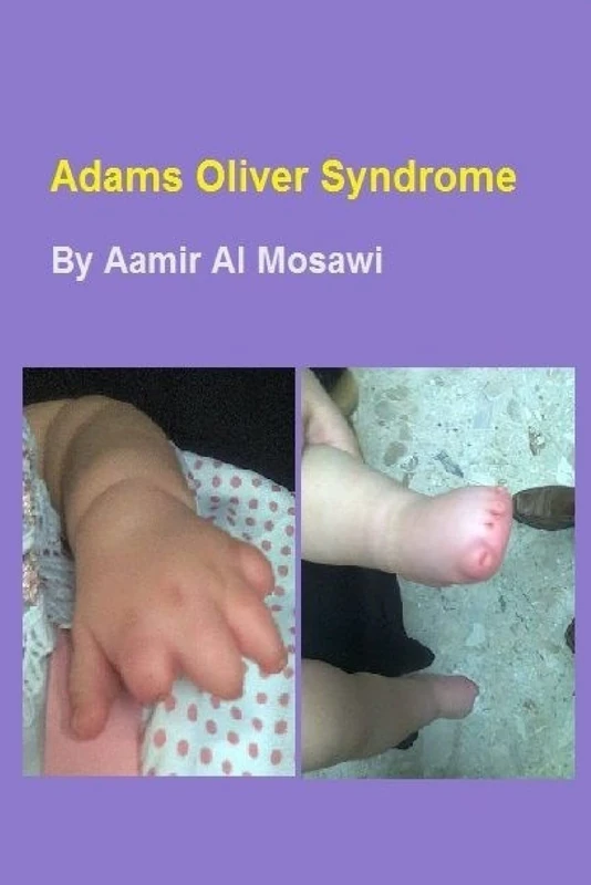 Adams Oliver syndrome: Clinical genetics - Image 1