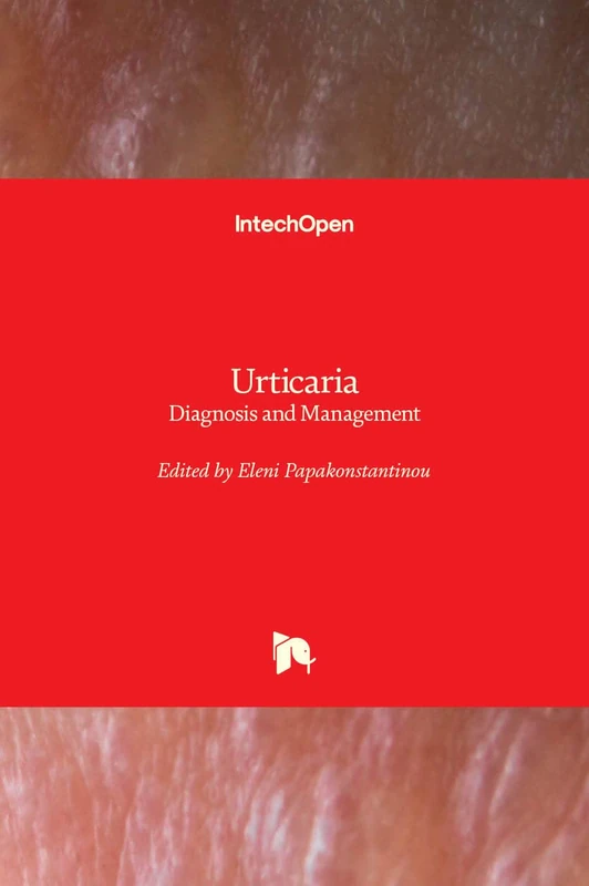 Urticaria: Diagnosis and Management