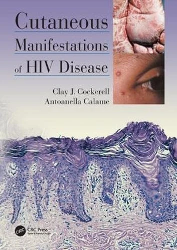 CRC Press - Cutaneous Manifestations of HIV Disease Book