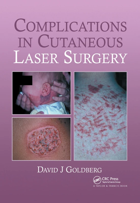 CRC Press - Complications in Laser Cutaneous Surgery Book