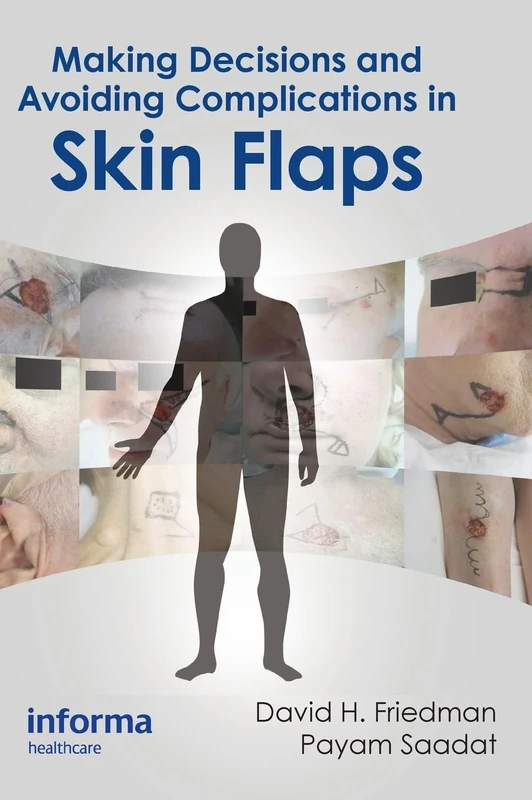 Making Decisions and Avoiding Complications in Skin Flaps