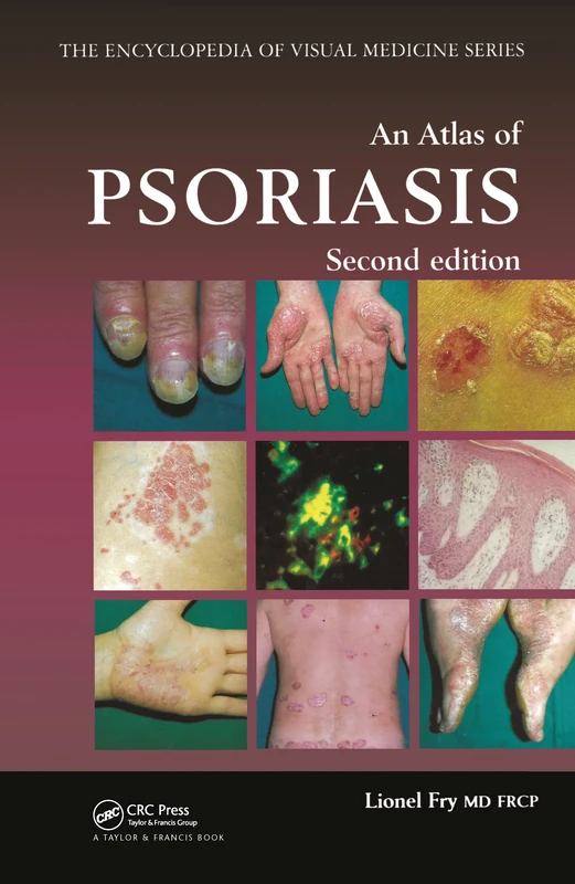 An Atlas of Psoriasis, Second Edition: 77 (Encyclopedia of Visual Medicine)