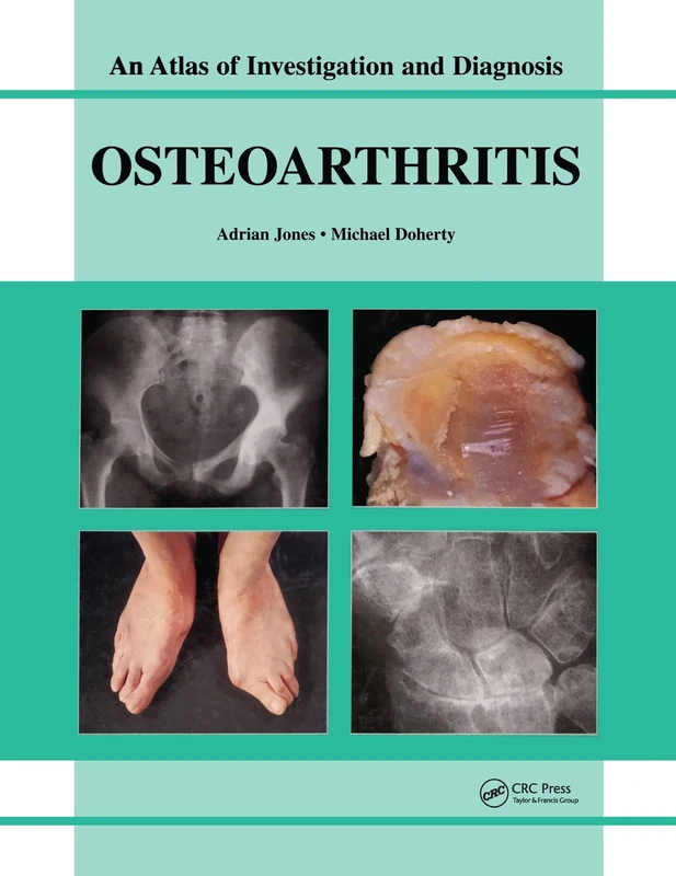 Oesteoarthritis: An Atlas of Investigation and Diagnosis