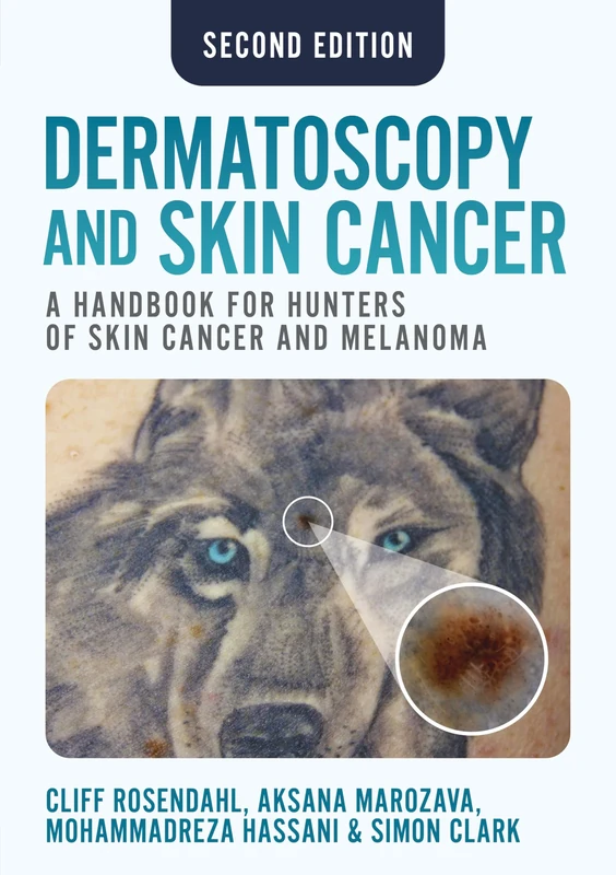 Dermatoscopy and Skin Cancer, second edition: A Handbook for Hunters of Skin Cancer and Melanoma