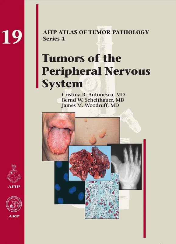 Tumors of the Peripheral Nervous System: No. 19 (AFIP Atlas of Tumor Pathology, Series 4,)