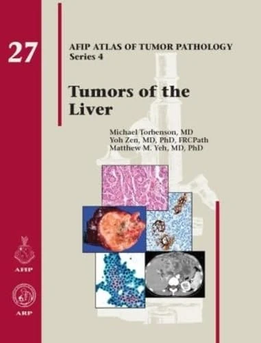 Tumors of the Liver: No. 27 (AFIP Atlas of Tumor Pathology, Series 4,)