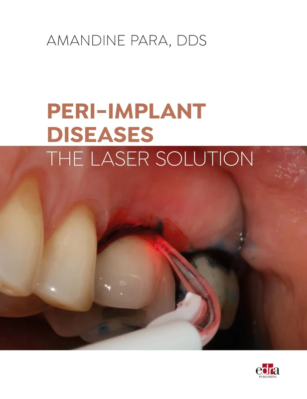 Peri-implant Diseases: The Laser Solution - Image 1