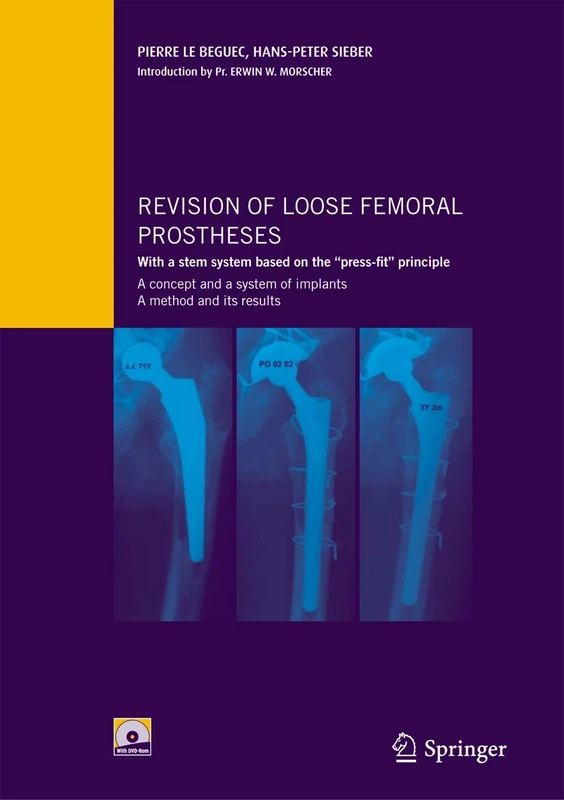 Springer Revision of Loose Femoral Prostheses - Medical Guide