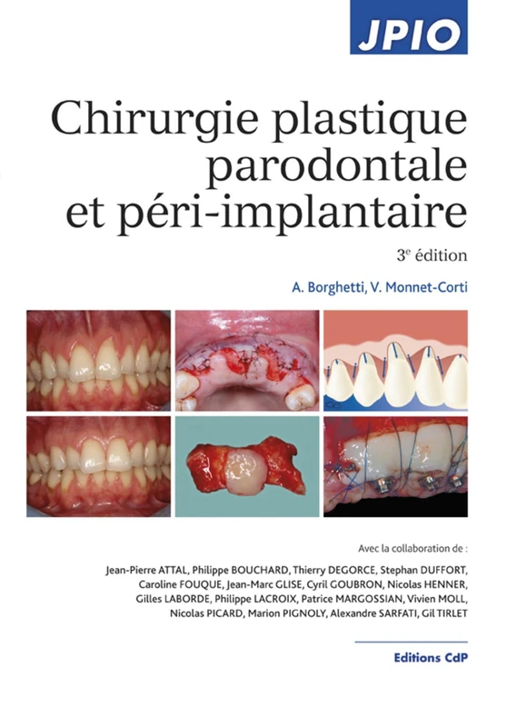 Chirurgie Plastique Parodontale Et Peri-implantaire - CDP Editions