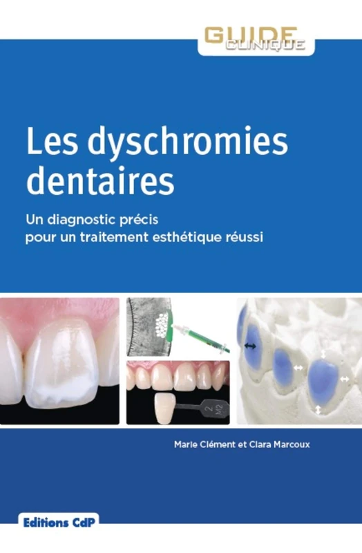 Les dyschromies dentaires: Un diagnostic précis pour un traitement esthétique réussi