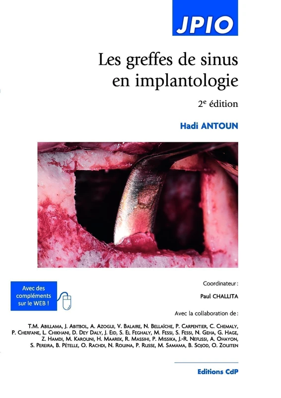 Les greffes de sinus en implantologie: 2E EDITION - CDP EDITIONS