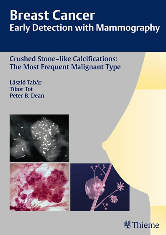 Breast Cancer: Early Detection with Mammography: Crushed Stone-like Calcifications: the Most Frequent Malignant Type (Tabar Mammo) - Image 1