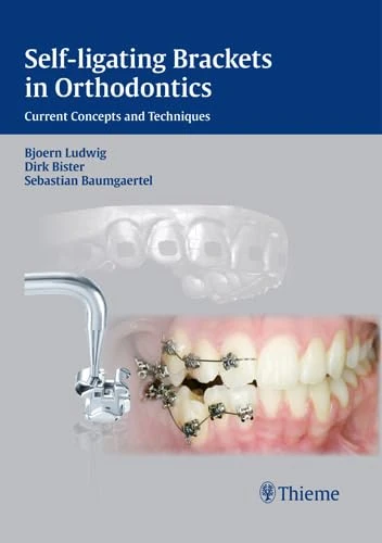 Self-ligating Brackets in Orthodontics: Current Concepts and Techniques