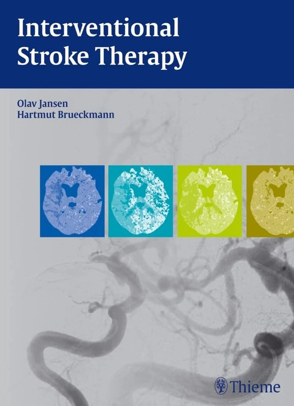 Interventional Stroke Therapy - Image 1
