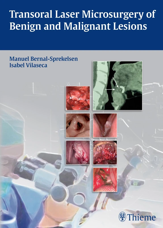 Thieme Transoral Laser Microsurgery of Benign and Malignant Lesions