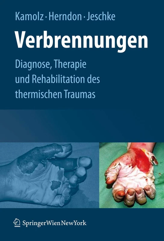 Verbrennungen: Diagnose, Therapie und Rehabilitation des thermischen Traumas - Image 1