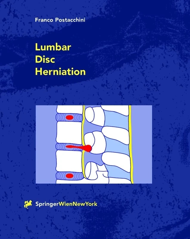 Lumbar Disc Herniation - Image 1