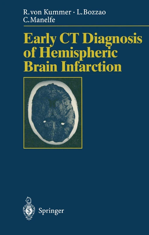 Early CT Diagnosis of Hemispheric Brain Infarction: VII