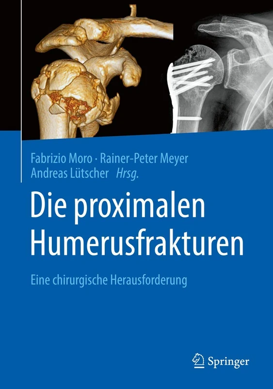 Die proximalen Humerusfrakturen: Eine chirurgische Herausforderung