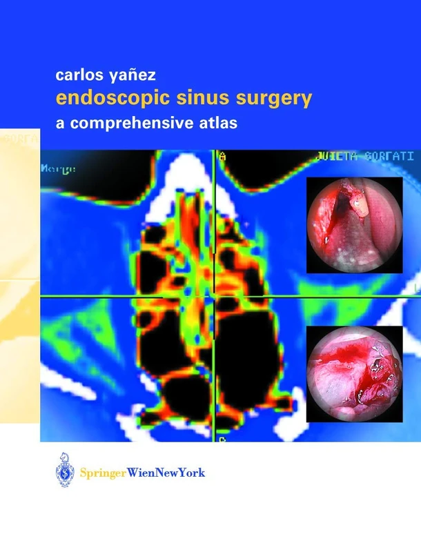 Springer Endoscopic Sinus Surgery: A Comprehensive Atlas