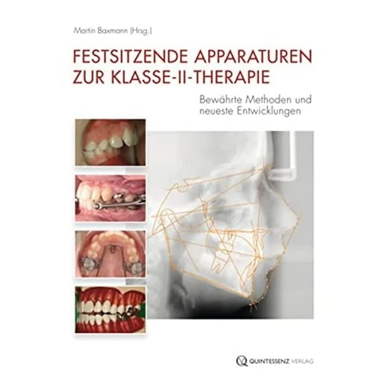 Festsitzende Apparaturen zur Klasse-II-Therapie: Bewährte Methoden und neueste Entwicklungen