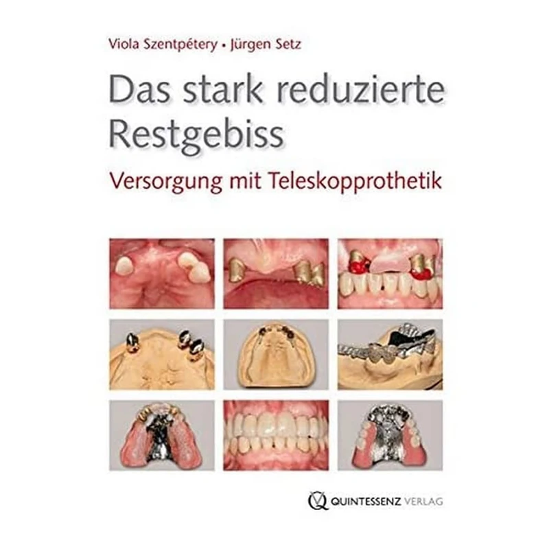 Das stark reduzierte Restgebiss: Versorgung mit Teleskopprothetik