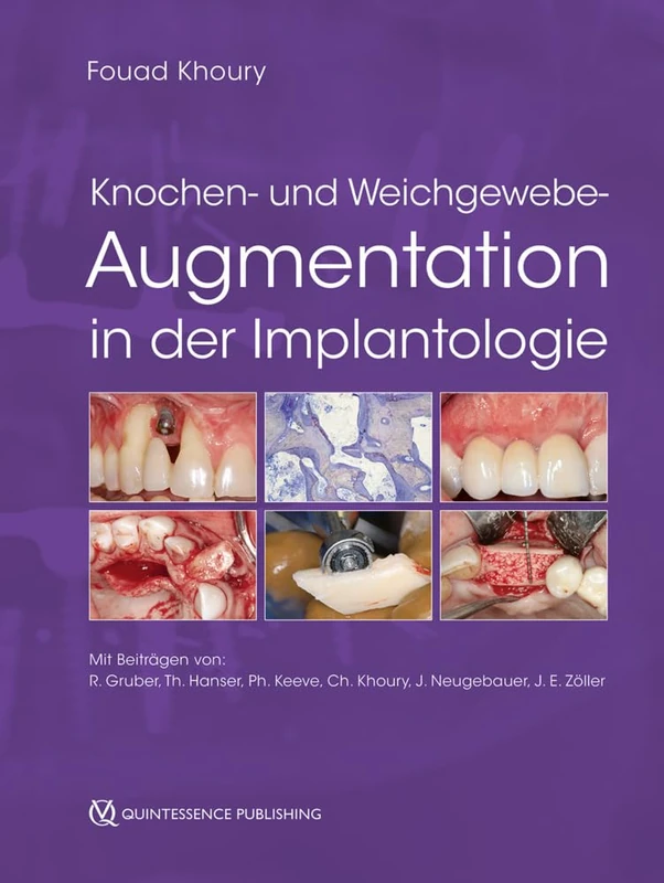 Knochen- und Weichgewebeaugmentation in der Implantologie - Image 1