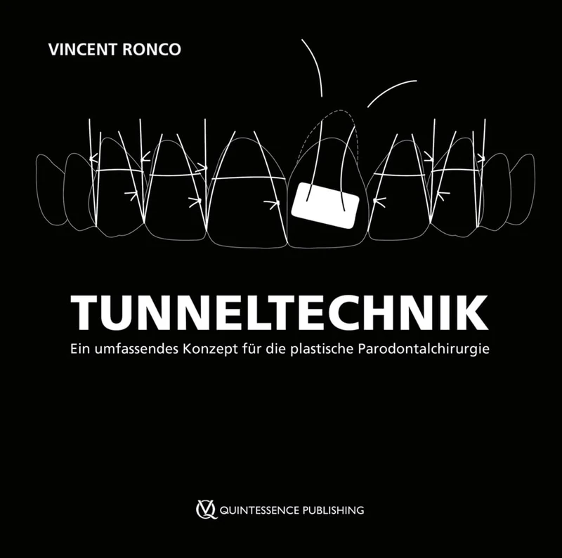 Tunneltechnik: Ein umfassendes Konzept für die plastische Parodontalchirurgie - Image 1
