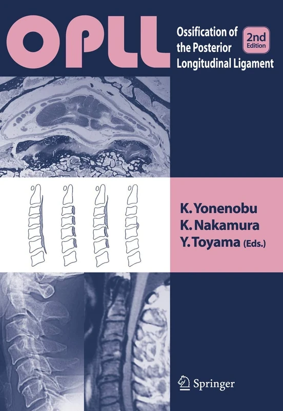 OPLL: Ossification of the Posterior Longitudinal Ligament - Image 1