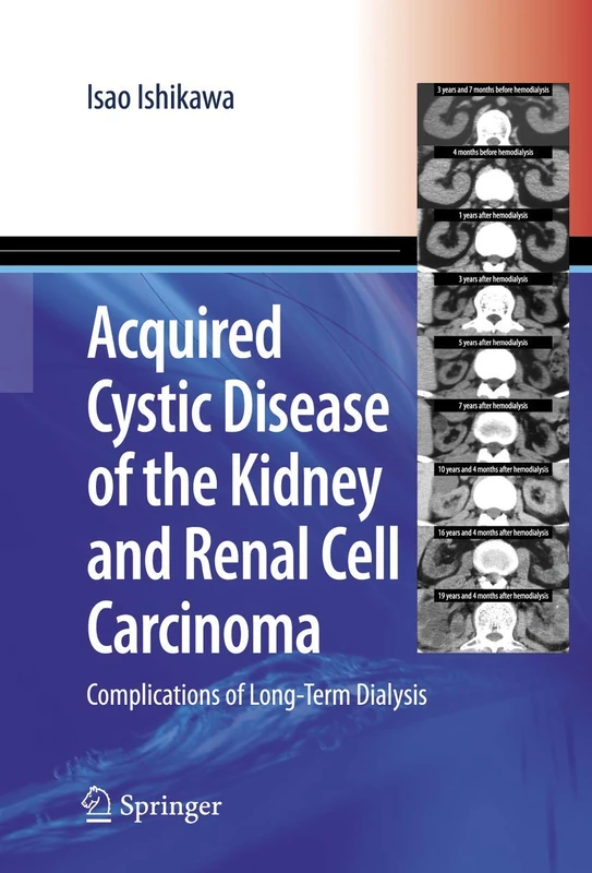 Acquired Cystic Disease of the Kidney and Renal Cell Carcinoma: Complication of Long-Term Dialysis