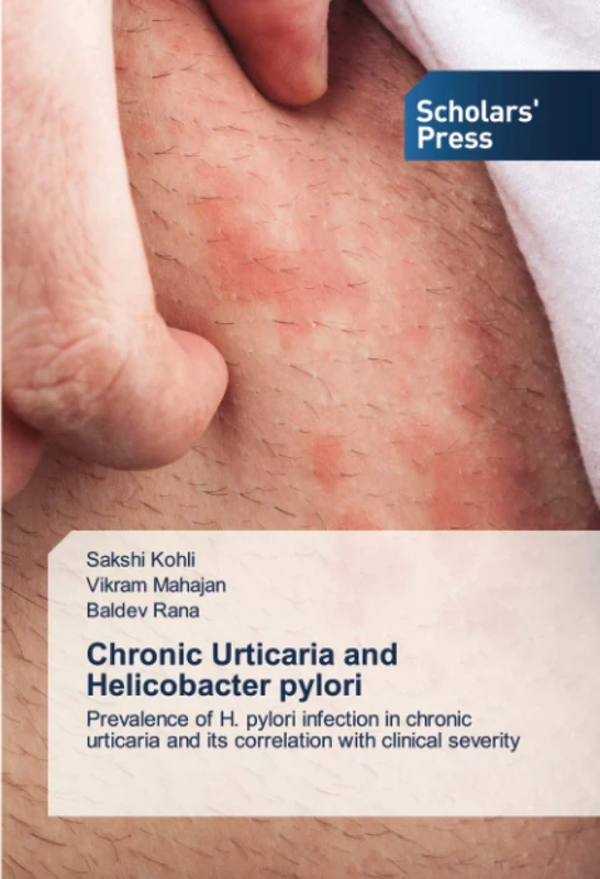 Chronic Urticaria and Helicobacter pylori: Prevalence of H. pylori infection in chronic urticaria and its correlation with clinical severity