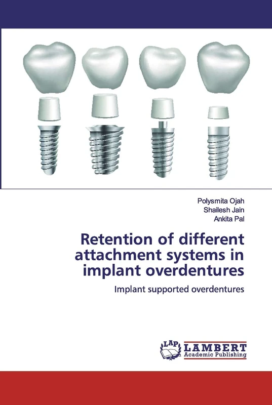 Retention of different attachment systems in implant overdentures: Implant supported overdentures