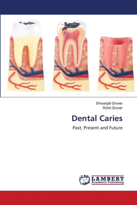 Dental Caries: Past, Present and Future